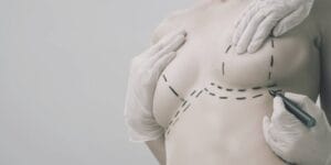 Cicatrices en la Mastopexia