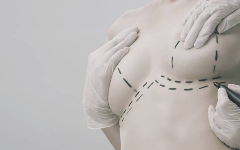 Cicatrices en la Mastopexia
