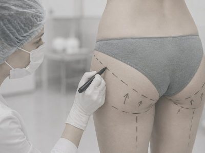 lipotransferencia gluteos lipotransferencia gluteos